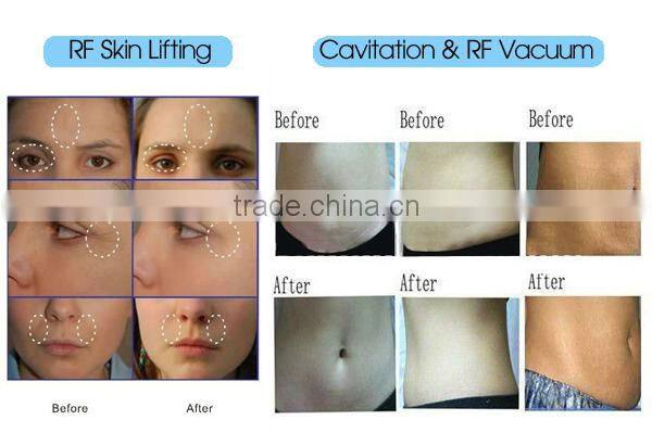 Factory price ultrasound cavitation and rf beauty machine