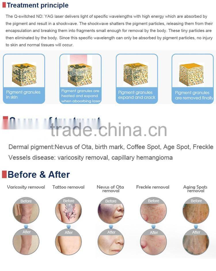 1064nm 532nm 1320nm pigment lesions removal varicose veins machine