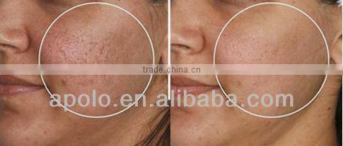 High tech wound removal q switched nd yag tattoo removal