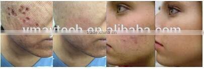 professional fractional co2 laser co2 fractional laser for wrinkle & scar removal,fractional co2 laser equipment VH612