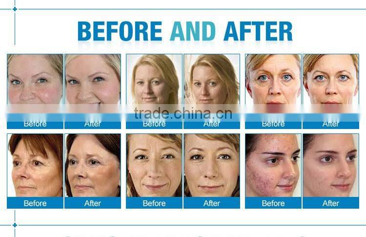 NL-SPA300 Hot sale Diamond Microdermabrasion Anti Aging Beauty Equipment