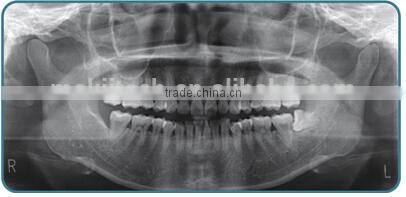 China Cheap Dental Panoramic and Cephalometric X-ray Machine