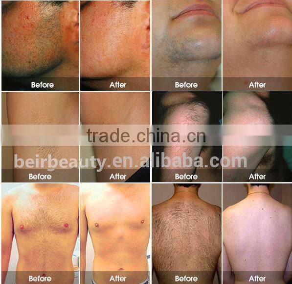 professional Newest 810mm portable High power CE approved diode laser hair removal 810nm