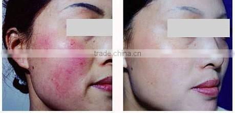 RBS03- Ramya diode laser 980nm RBS vascular vein stopper removal machine