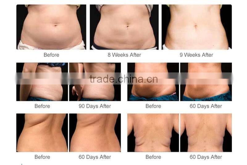 Hot sell 2016 body shaping machine cool tech fat freezing slimming machine