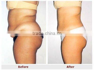 Strong machine that remove belly fat ultrasonic cavitation device