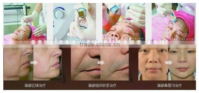 alibaba china fashion fractional rf machine