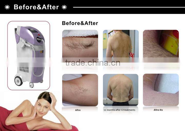 808nm Diode Laser Hair Epilator