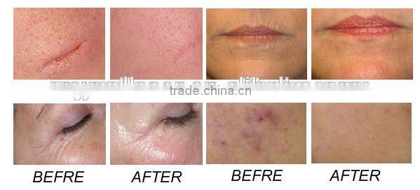 Best Selling in USA Professional Fractional Co2 Laser Stretch Mark Removal Machine