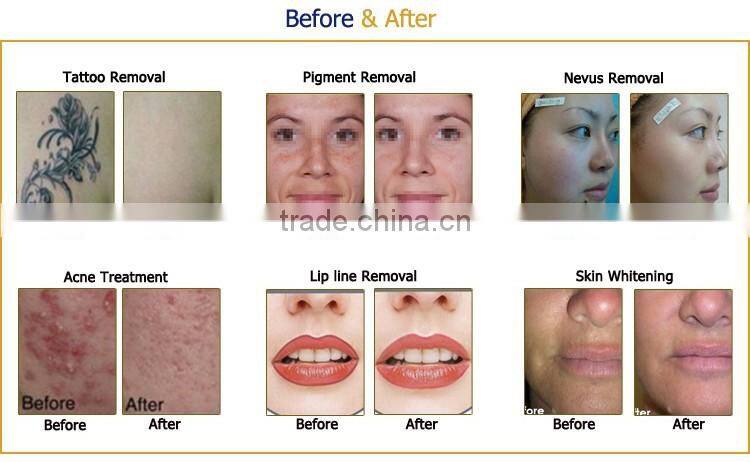 PicoSecond laser new laser for tattoo removal pigment removal