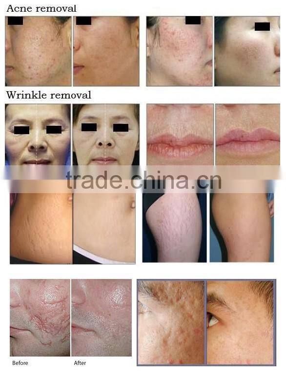 Newest CO2 laser machine laser co2 fractional,fractional co2 laser equipment,co2 laser