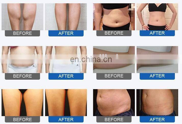 Hot selling body slimming weight loss machine with vacuum rf cavitation body sculpting beauty device