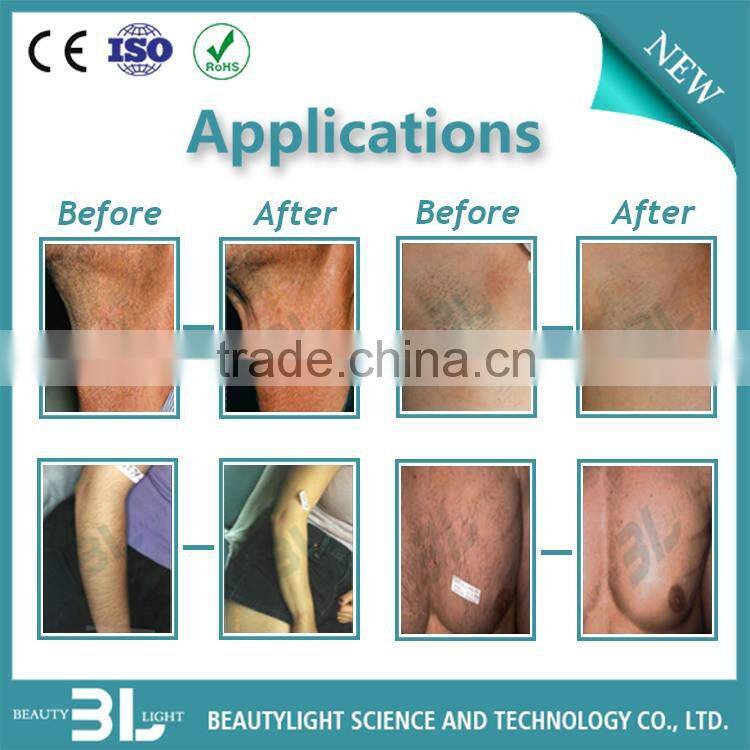 808nm diode laser hair removal machine, laser hair removal best machine, hair removal