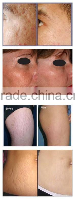 2015 Vaginal tightening Fractional Co2 laser co2 fractional laser