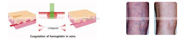 ce approved painless 1320nm 1064 nm 532nm gentle long pulse pigments tattoo removal varicose veins laser treatment q switch nd