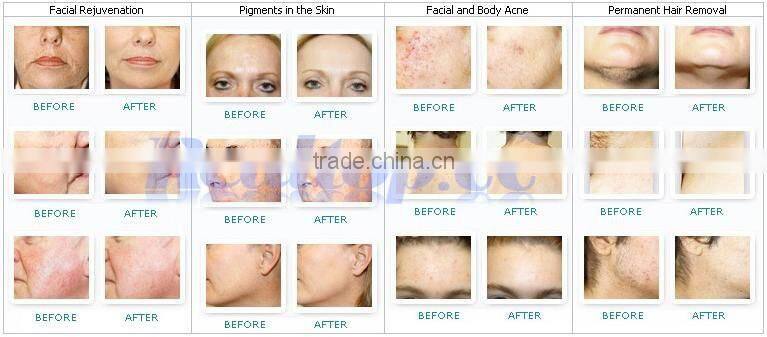 factory direct wholesale !!laser opt rf ipl rf shr hair removal YAG yag laser tattoo removal equipment