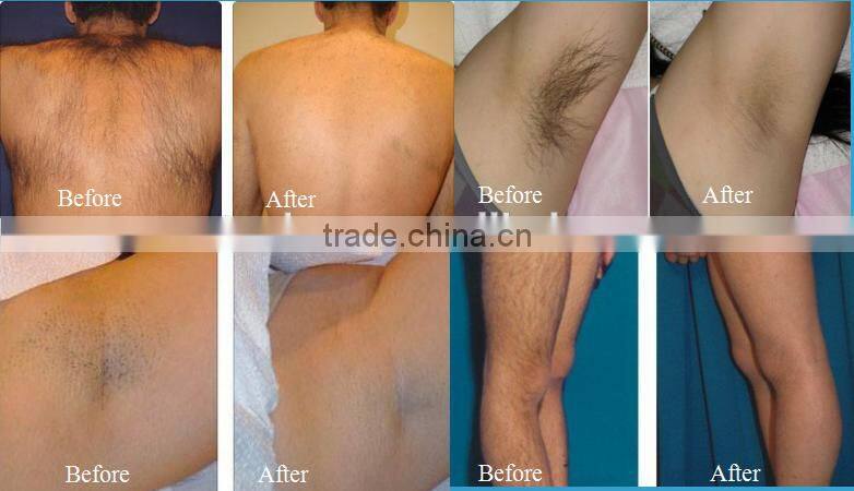Most popular diode laser hair removal/ laser diode 808nm hair removal