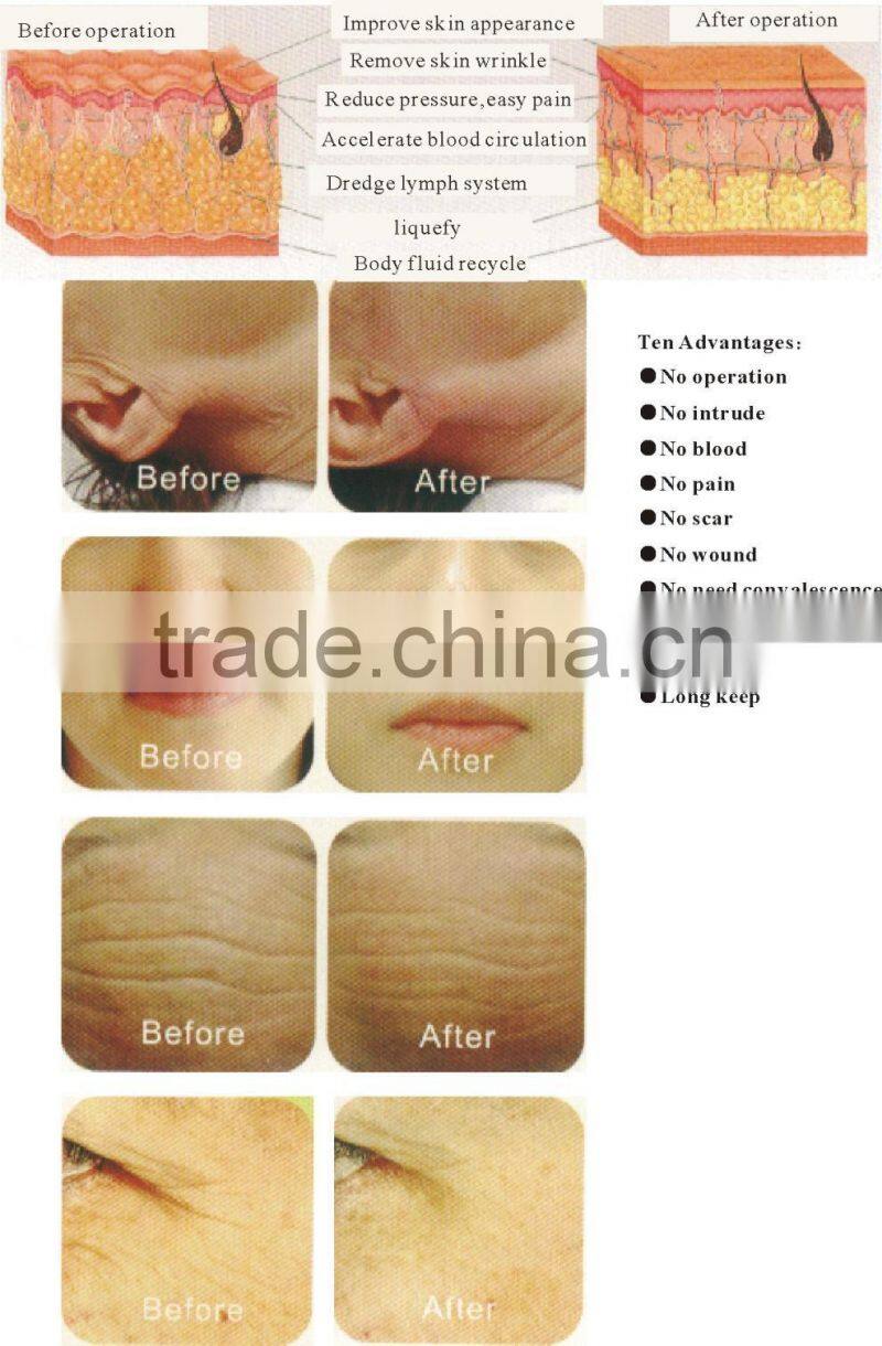 hot monopolar rf radio frequency skin care machine tm-rf02