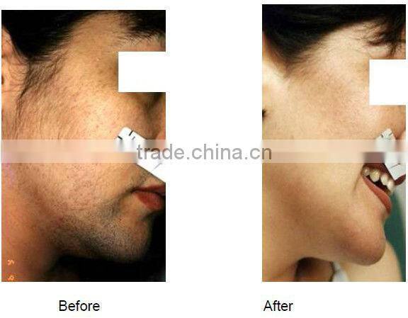 Professional hair removal machine laser diode 808 nm