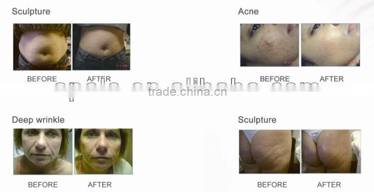 New arrival!!! RF Machine for Face Lifting from Med-Apolo