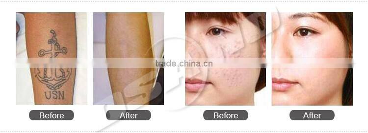 Body tattoo removal q switched nd yag laser machine