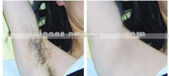 Agent wanted! permanent hair removal/all kinds hair treatment 755nm gentle laser machine