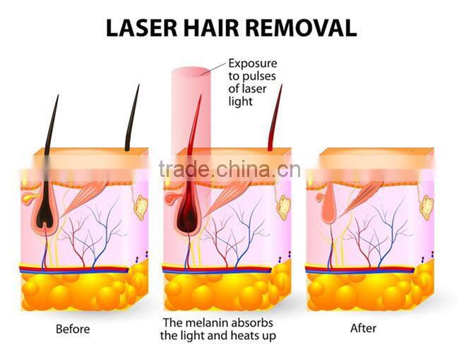 looking for exclusive distributor for body hair removal diode laser machine