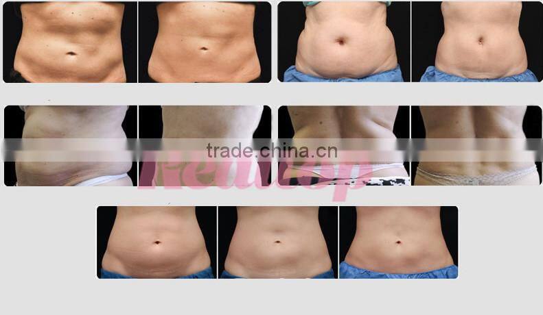 Newest model cryo-lipolysis cryotherapy freezing fat removal cellulite machine!weight loss lipo cryo machine on sale promotion