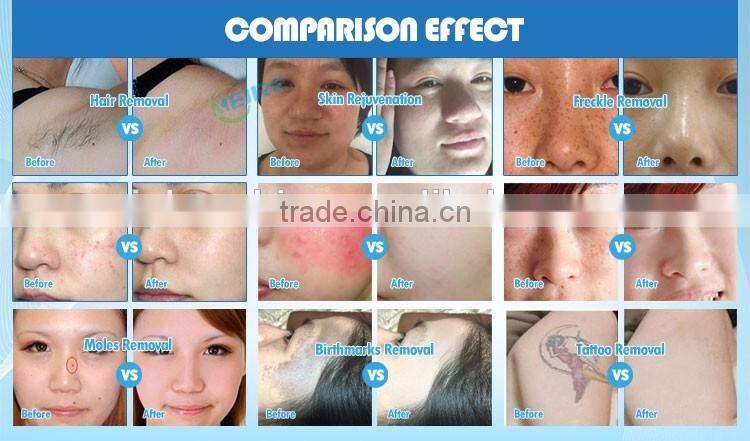 OPT SHR Laser Multifunction Beauty Machine of ipl hair removal device