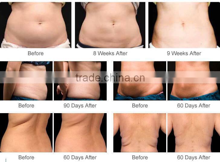 Medical CE Approved Criolipolysis Crio Lipolysis Criolipolisis Machine