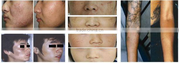 permanent laser tattoo/pigmentation corrector acne removal machine Q switch nd yag laser