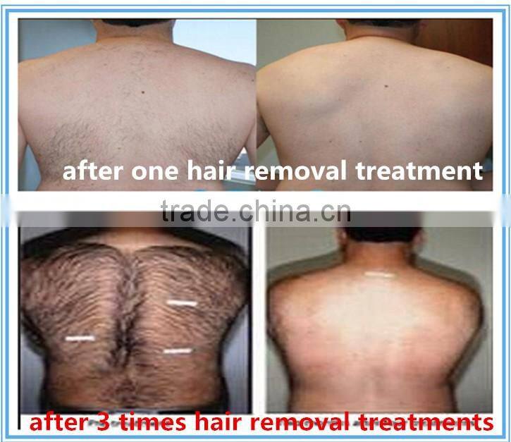 Professional laser hair removal 808nm laser diode / 810nm diode laser