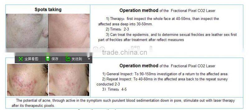 CO2 pixel laser for beauty salon/ Pixel laser /Pixel laser Co2 machine