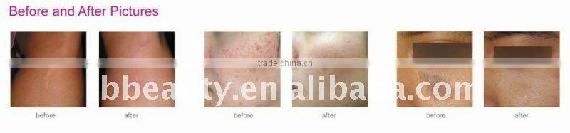 medical co2 fractional skin lifting acne removal tighten laser beauty machine