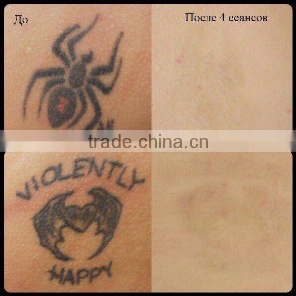 532/1064/1320nm q switched nd yag laser tattoo removal beauty salon equipment