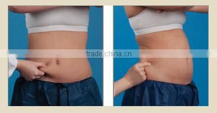 2016 Most advanced High Intensity Focused ultrasound HIFU body slimming lipo hifu machine/ HIFU slimming machine