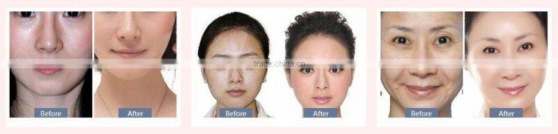 3 in 1 beauty machine hot cold hammer