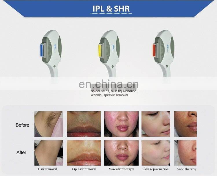 Powerful Germany Xenon Lamp SHR laser hair removal machine for sale