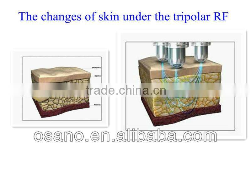 osano portable rf slimming machine - rf radio frequency ultrasound cavitation machine for sale lower price !