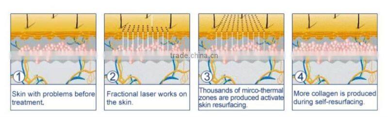 Effective women deep wrinkle removal CO2 fractional RF tube machine