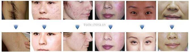 Best choice for beauty salon device White SHR(super hair removal) and IPL beauty handle