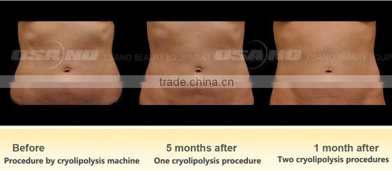 Fat Freezing Criolipolisis Lipocavitation Machine multifunction machine aesthetics
