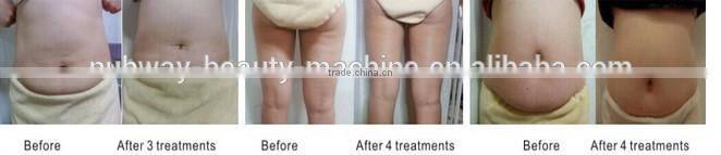 2015 new design portable HIFUSHAPE slimming machine high intensity focused ultrasound hifu