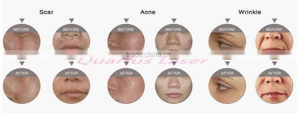 High-tech fractional co2 laser/rf tube co2/fractional laser/ co2 fractional laser