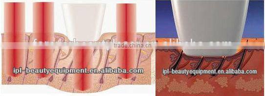 808nm Diode Laser Hair Epilator