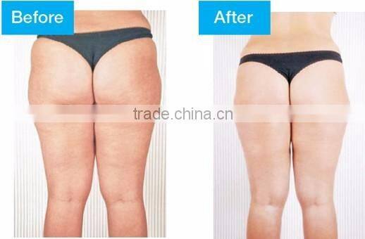Lipo Laser Fat Reduction Product Body Sculpture Lipo Laser dual wave Medical Diode Laser