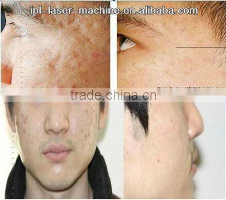 High performance !!! best fractional rf needle for sale