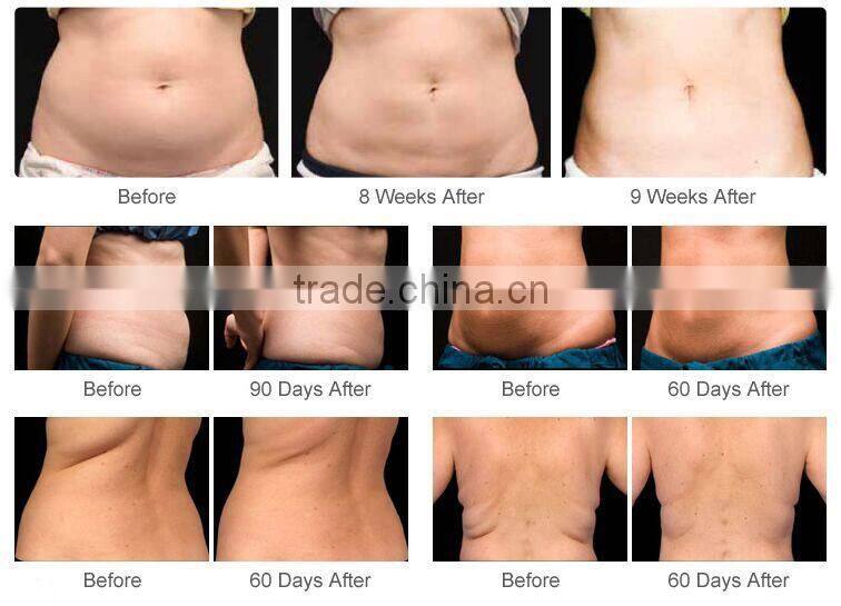 CE Certificated cryotherapy equipment Cavitation & RF & lipo laser Cryolipolysis lipo machine with teaching video