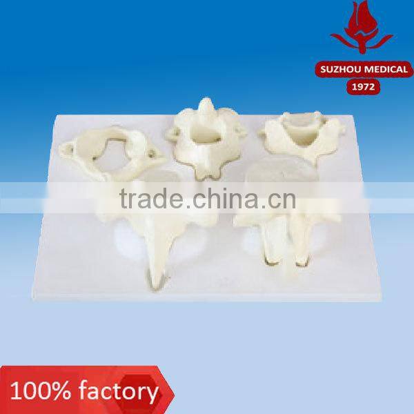 Enlarged atlas axial cervical thoracic and lumbar