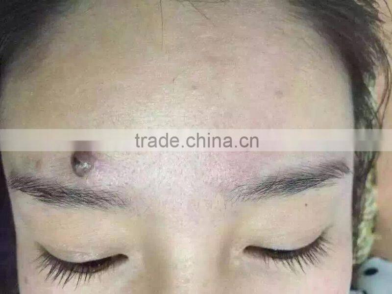 2015 New Wholesale Professional mini Tatoo Spot Mole Laser Remover freck spot removal laser pen